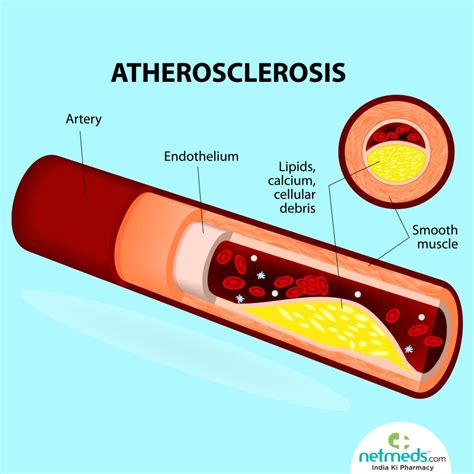 atherosclerosis pictures